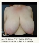 breast-reduction-patient-33-1-1 copy.jpg