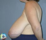 breast-reduction-25-view-3-detail (1).jpg