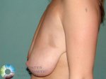 breast-lift-504-left-side-detail.jpg