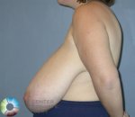 breast-reduction-25-view-3-detail.jpg