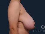 breast-reduction-for-women-2105-right-side-detail.jpg