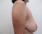 breast-reduction-006-780x300.jpg