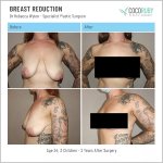9_7_22_breast-reduction_dr-rebecca-wyten_IDRW79 copy.jpg