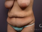 tummy-tuck-243-view-4-detail.jpg