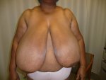 Breast-Reduction-before-632435-765248.jpg