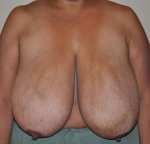 Breast-reduction-before-530711-509862.jpg