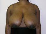 Breast-reduction-before-310447.jpg
