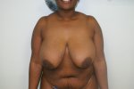 Breast-lift-before-365713.JPG
