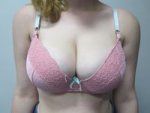 8__pre_op_bra_2_resized.jpg