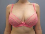 post_op_bra_2_141_resized.jpg