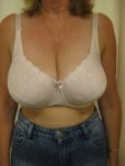 pre_op_bra_21_resized.jpg